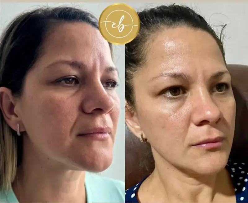 Una Sesión de Peeling - Antes y después