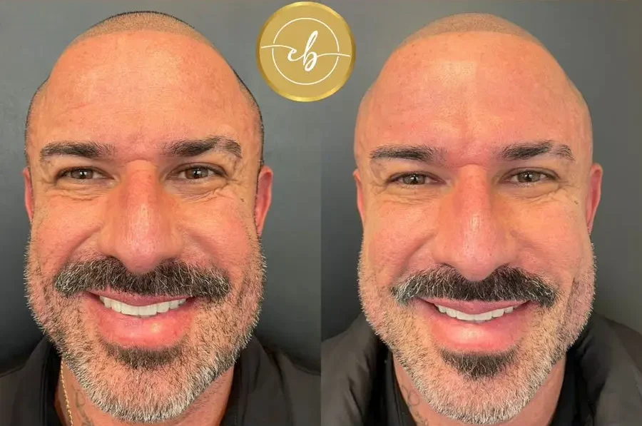 Antes y después de nuestro influencer - Tratamiento de Toxina Botulinica y 1 Filler para ojeras