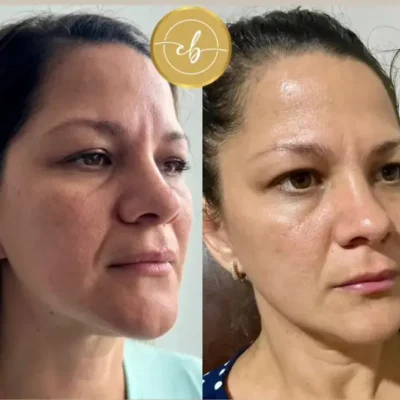 Una Sesión de Peeling - Antes y después