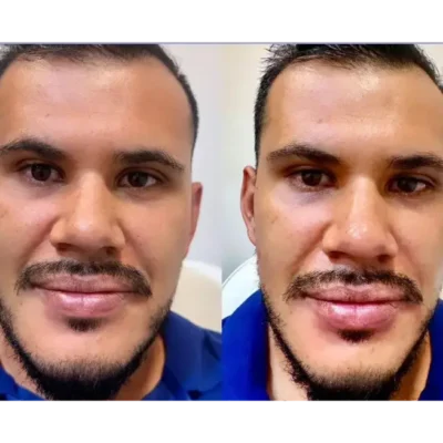 Face Workout - Antes y después